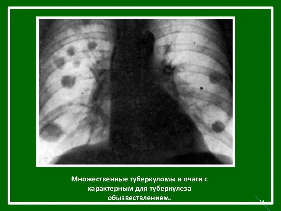 Туберкулез легкого рентгенограмма. Рентген туберкулез туберкулема. Туберкулома туберкулез рентген. Туберкулема патологическая анатомия. Туберкулез рентгенологические снимки.