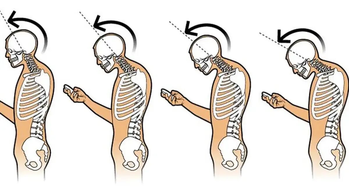 Синдром компьютерной шеи. Сутулость скелет. Текстовая шея. Компьютерная шея искривление позвоночника.