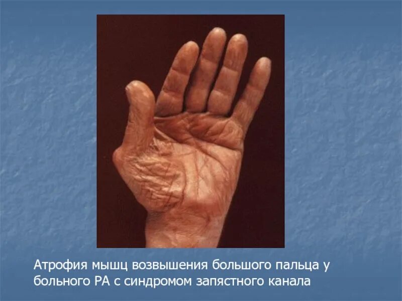 Атрофия кисти руки. Атрофирование мышц кисти. Атрофия межкостных мышц. Атрофия кисти руки. Атрофия межкостных мышц.