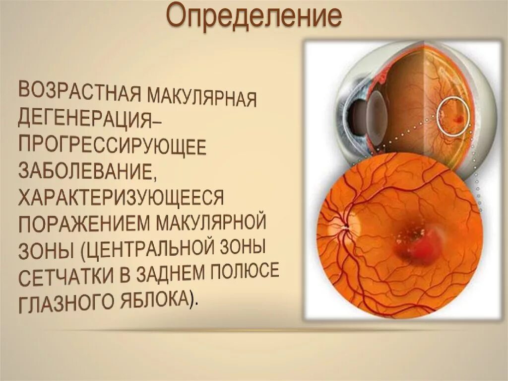 Лечение дегенерации макулы. Макулодистрофия, макулярная дегенерация; ретинит;. Возрастная макулодистрофия глазное дно. Возрастная макулярная дегенерация глазное дно. Сухая форма центральной дистрофии сетчатки.