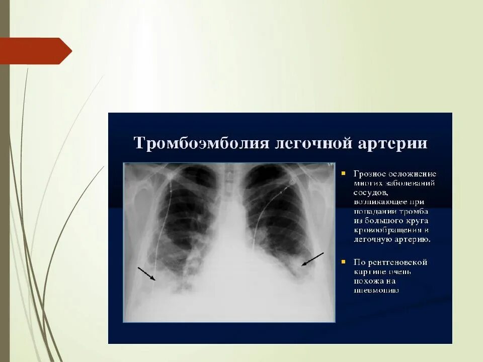 Разрыв легочной. Тромбоэмболия легочной артерии рентген. Расширение легочной артерии рентген. Тромбоэмболия легочной артерии рентген признаки. Тэла рентгенологическая картина.