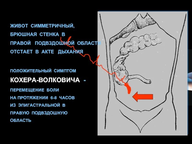 Боли в животе при остром аппендиците. Симптом кохера-Волковича. Симптом Палкович кохера. Симптомы аппендицита Волковича.