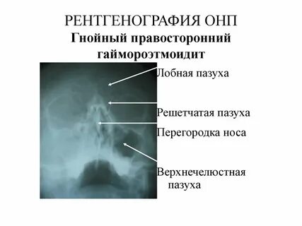 Онп что это такое