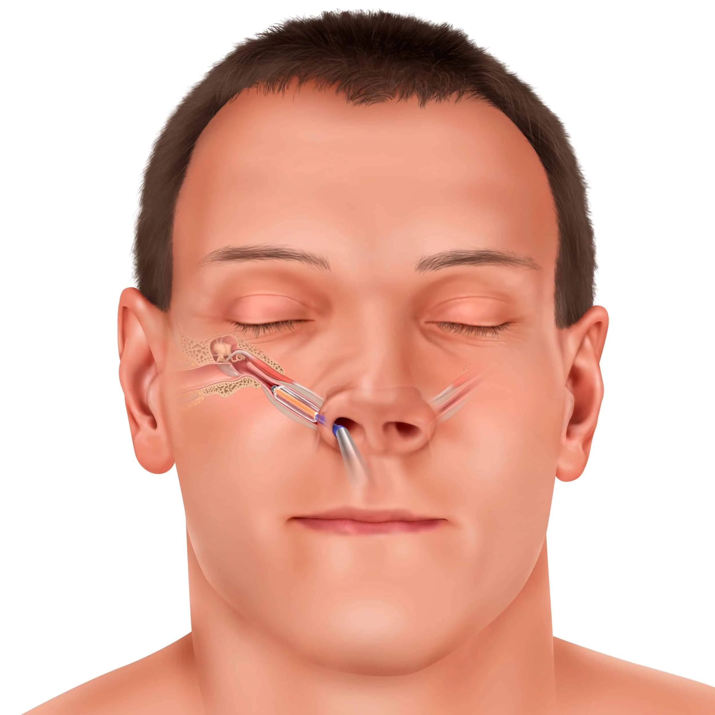 Nasal Tilt. Treatment of Nasal Septum. Sinusitis man.