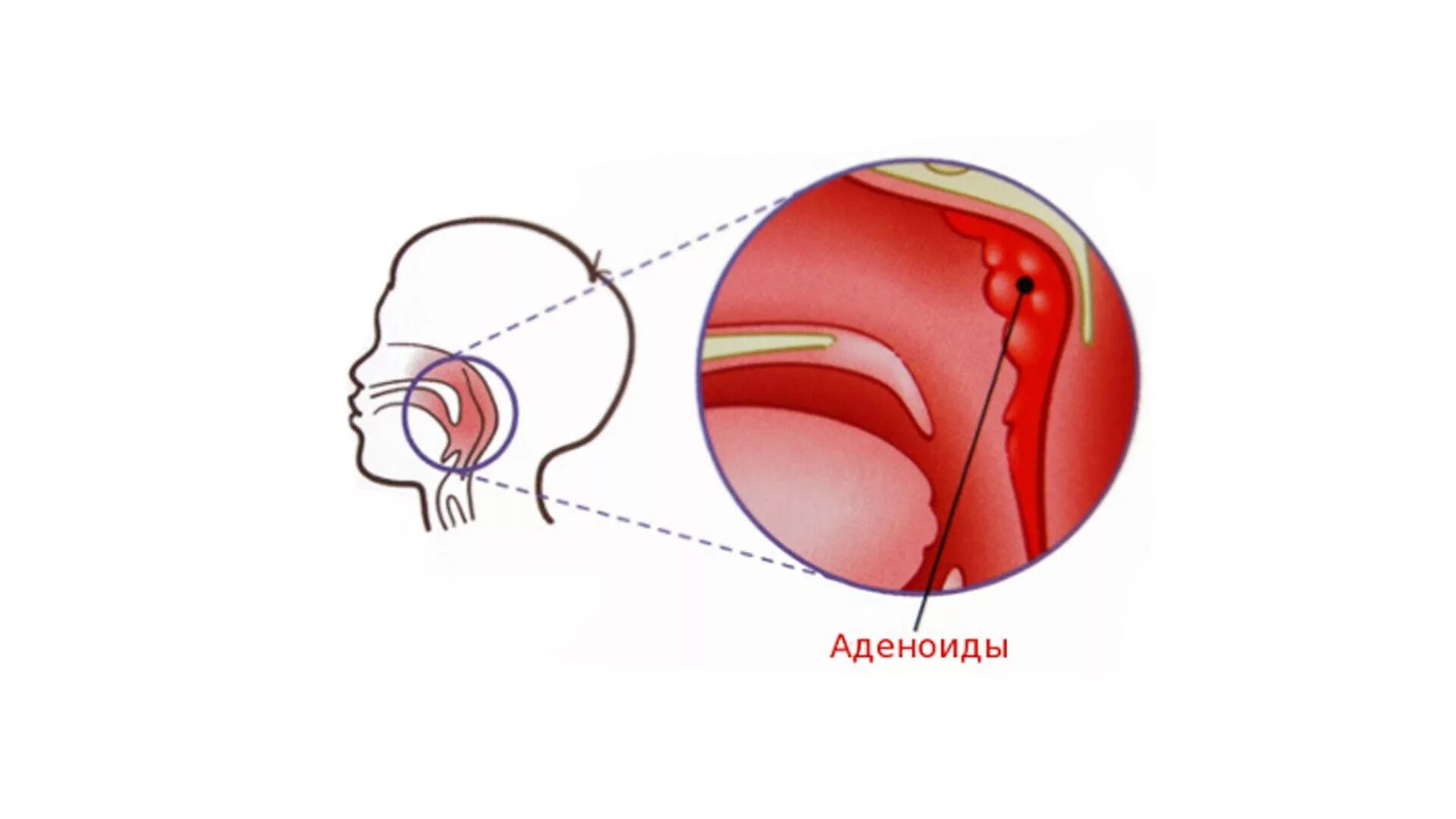 Анатомия носоглотки аденоиды.