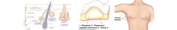 Как снять воспаление жировика в домашних условиях Удаление моллюска лазером в Москве, приятная цена