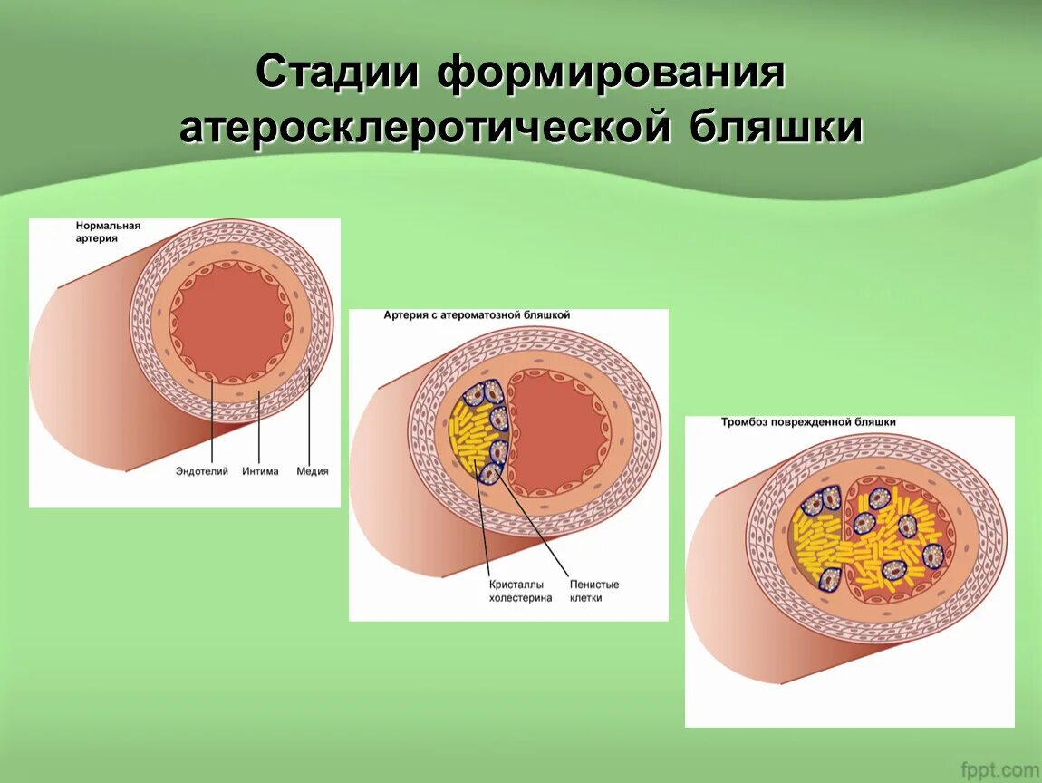 Стадии атеросклеротической бляшки. Фазы формирования атеросклеротической бляшки. стадии развития атеросклеротической бляшки. этапы формирования атеросклеротической бляшки. стадии развития бляшки.