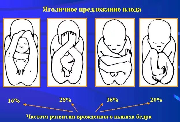 Тазовое предлежание мальчика. Продольное положение ягодичное предлежание. Продольное тазовое предлежание 1 позиция. Ягодичное предлежание плода позиция 1. Продольное ягодичное положение плода.