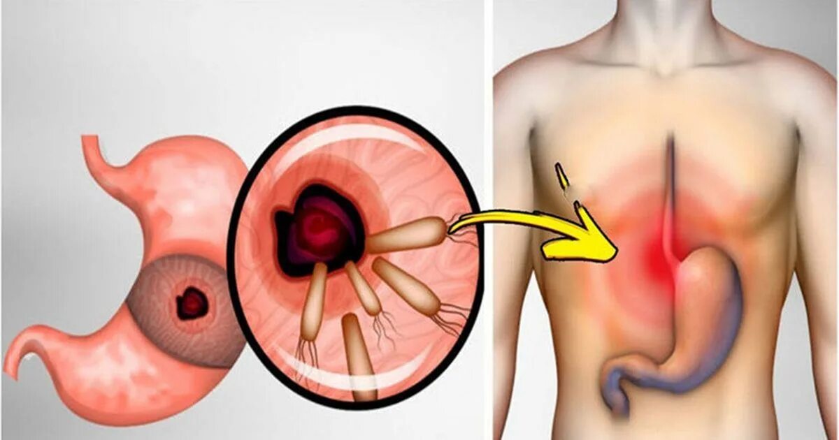 Заболевания пищеварительной системы язва. Живот при язве желудка