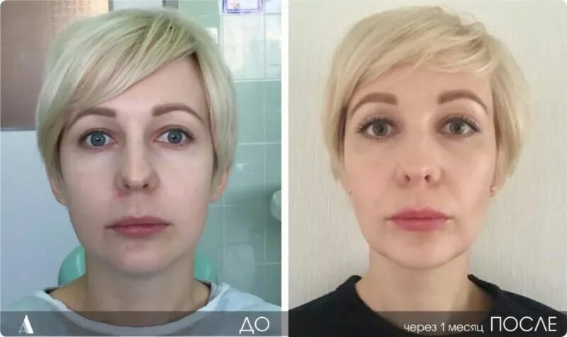 Комки биша что будет в старости ActualBeauty