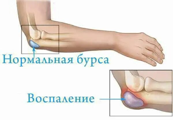 Собирается жидкость в суставах. Надмыщелковый бурсит локтевого сустава. Бурсит локтевого отростка классификация. Гнойный бурсит локтевого отростка. Жидкость в локтевом суставе.