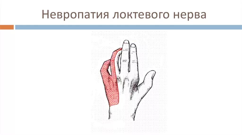 Повреждение локтевого нерва. Вид кисти при поражении локтевого нерва. Нейропатия локтевого нерва клиника. Положение кисти при невропатии локтевого нерва. Нейропатия локтевого нерва синдром.