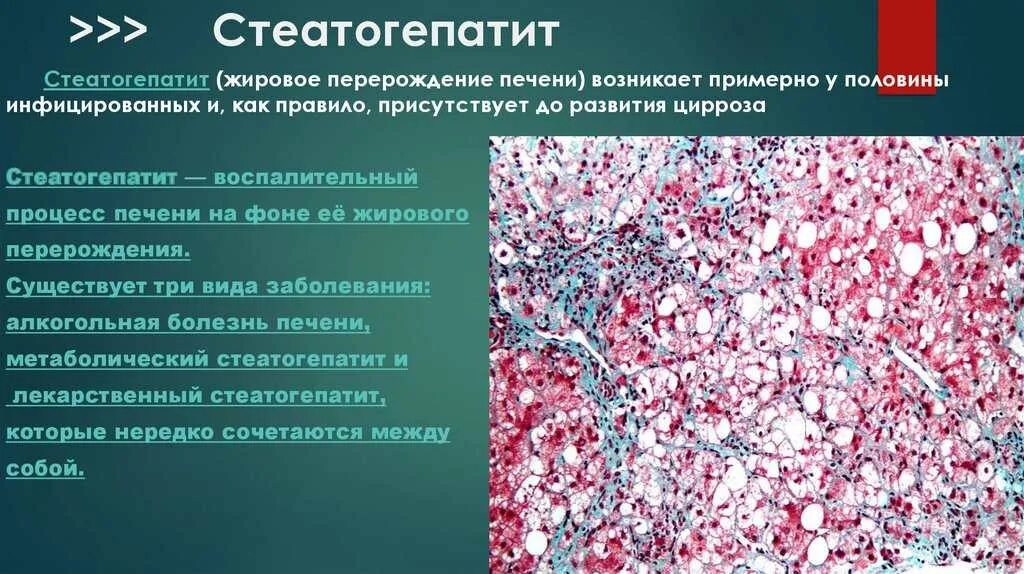 Стеатогепатит (гепатит) печени. Стеатогепатит и гепатоз. Жировая болезнь печени – стеатогепатит. Алкогольный стеатоз печени симптомы. Алкогольная жировая болезнь