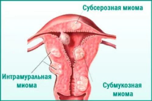 Воспаление слизистой оболочки влагалища. Воспаления слизистых оболочек влагалища.