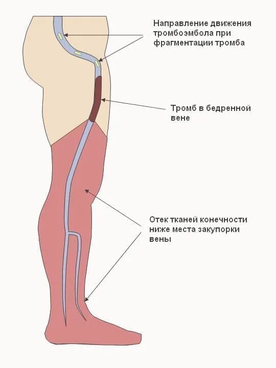 Тромбоз бедренных вен