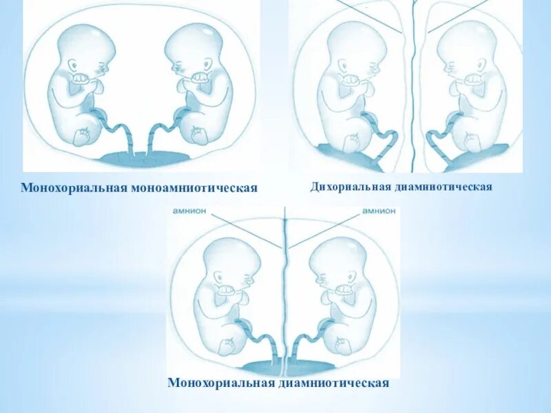 Многоплодная беременность положение плодов. Многоплодная беременность типы плацентации. Многоплодная беременность плацента. Варианты двоен. Многоплодная беременность расположение плодов.