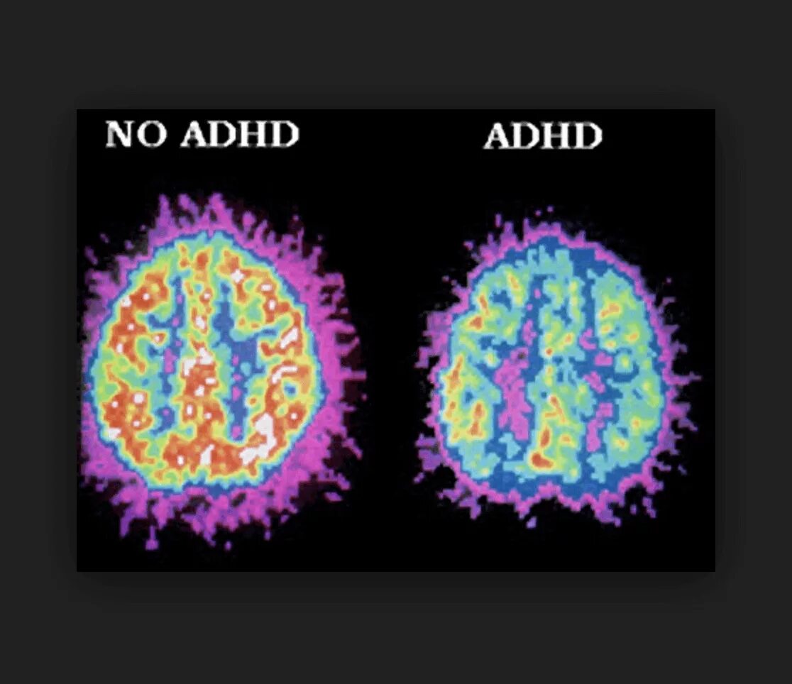 Английский brains. ADHD Brain. Normal Brain and ADHD Brain. ADHD Brain structure. Школы английского Brain.