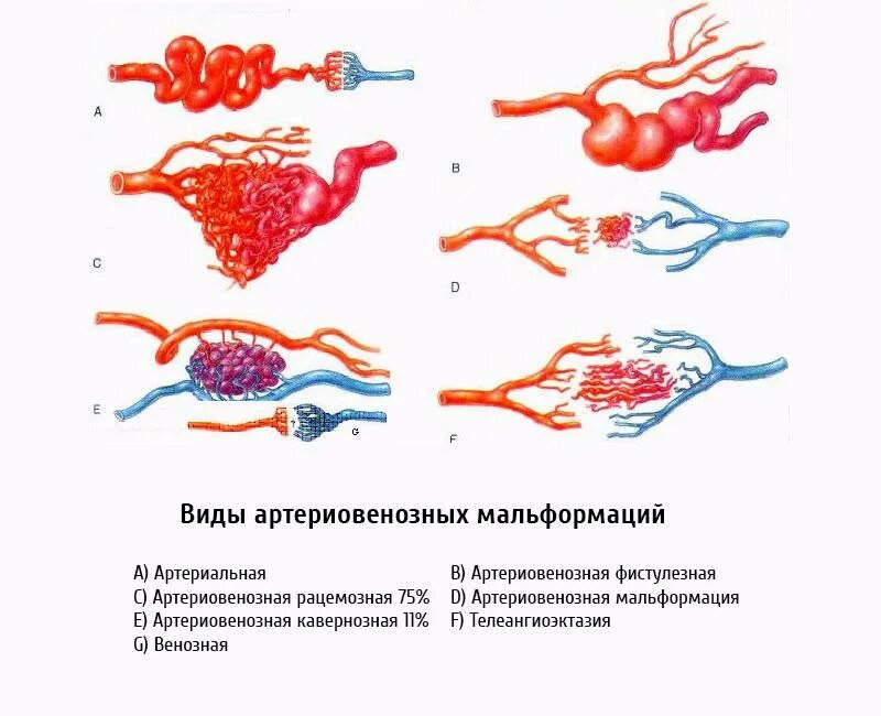 Сосудистая аномалия. Артериовенозная мальформация сосудов. Артериально-венозная мальформация головного мозга. Классификация мальформаций головного мозга. Артериовенозная мальформация классификация.