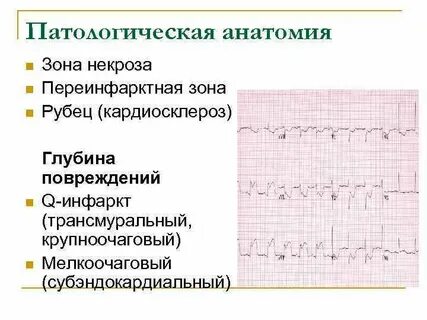 Трансмуральный инфаркт передней стенки