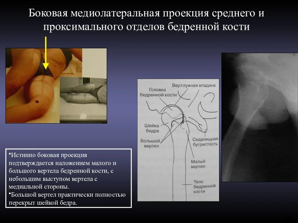 Проекции рентгена тазобедренного сустава. Проксимальный отдел тазобедренного сустава. пароксизмалтный отдел бедренной кости. проекция бедренной кости. проксимальный отдел бедренной кости.