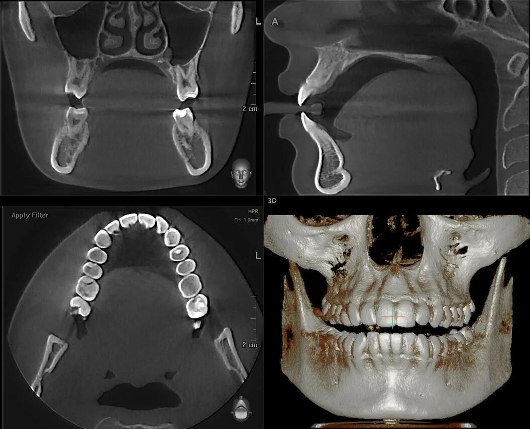 Имплант и мрт можно ли. Кт 2 челюсти гайморовы пазухи.