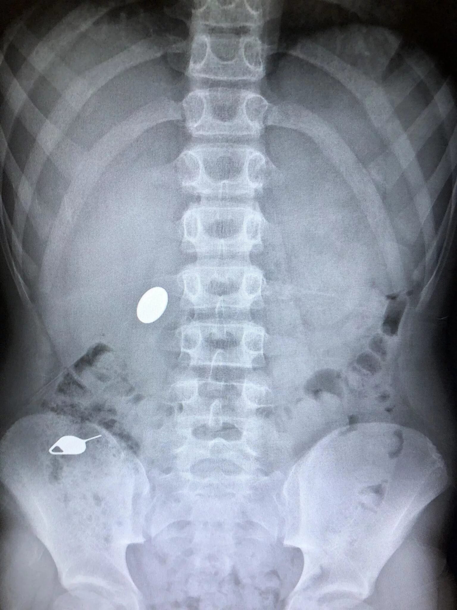 Проглотил через сколько выйдет. Ребенок проглотил монету рентген. Монета в желудке рентген. Проглоченная монета на рентгене.
