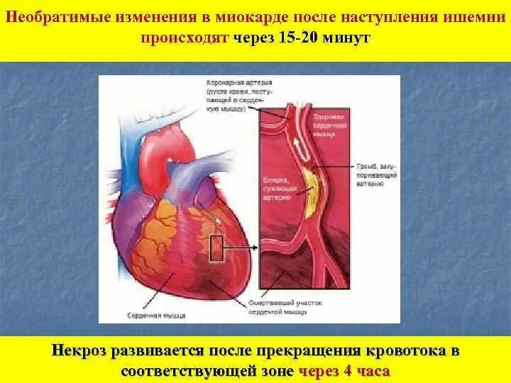 Глубокие необратимые изменения. Изменения в миокарде. Необратимая ишемия миокарда. Изменения миокарда,что это некроз. Преходящие эпизоды ишемии миокарда.