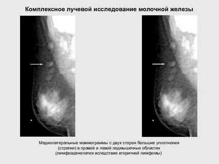 Уплотнение в соске у девочки