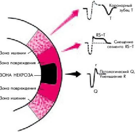 Зона повреждения на ЭКГ. Медкампус схема. Им с зубцом q. Ишемированная зона сердца. Зона ишемии