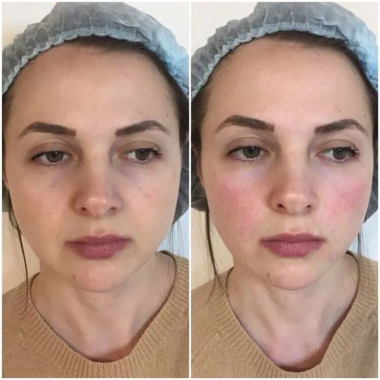 скулы филлерами. моделирование лица филлерами. скулы филлерами. скулы спб. сеул до и после.