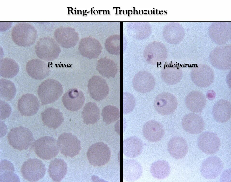 Plasmodium falciparum гаметоцит. Plasmodium falciparum трехдневная малярия. Plasmodium falciparum это возбудитель. Малярийный плазмодий Вивакс. Тяжелое течение малярии ассоциируется чаще