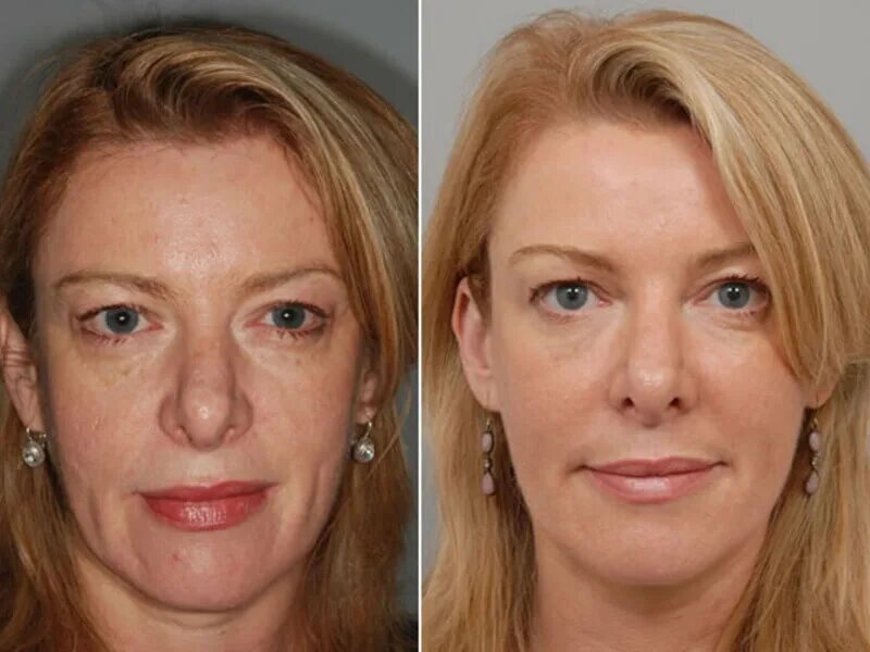 Подтяжка лица до и после. Можно делать массаж после биоревитализации