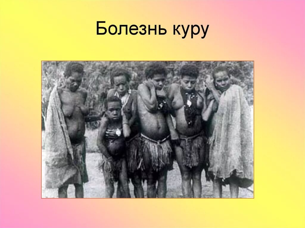 Картинки БОЛЕЗНЬ КУРУ ПРИЧИНЫ