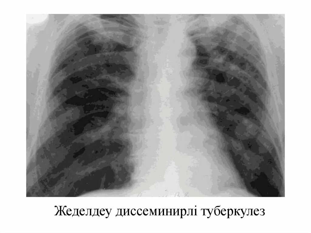 Диссеминированный туберкулез легких фазы. Подострый диссеминированный туберкулез рентген. Острый диссеминированный туберкулез рентген. Хронический диссеминированный туберкулез рентген. Подострый диссеминированный туберкулез рентгенограмма.