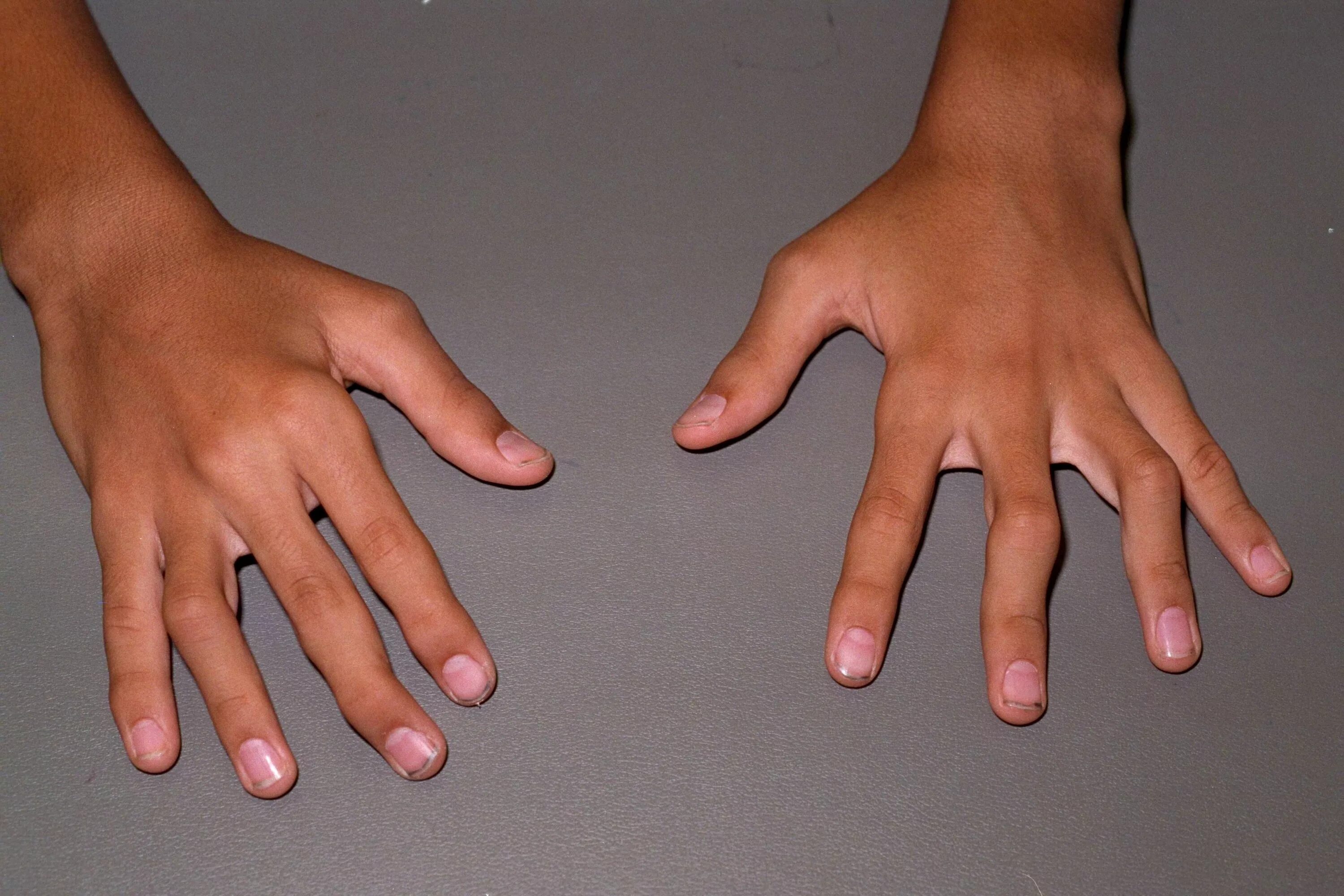 Почему пальцы можно. Ревматоидный артрит полиартрит. Ревмотоиднийполиортрит. Ювенильный ревматоидный полиартрит.
