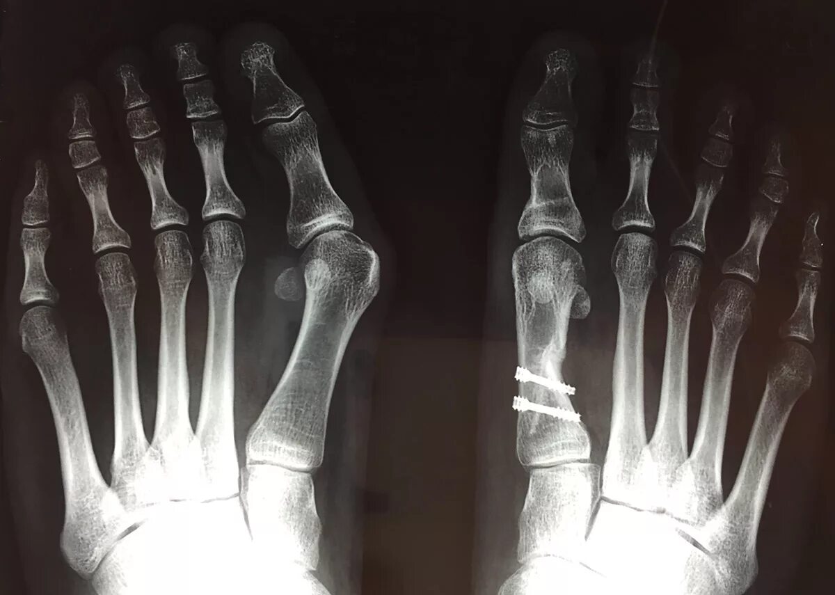 Рентген стопы халюс вальгус. Hallux valgus степени рентген рентген. Рентгенограмма стопы hallux valgus. Hallux valgus что это