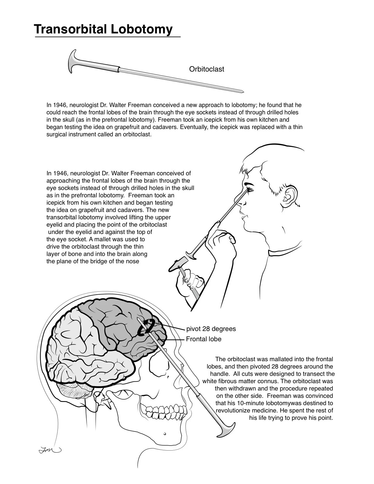 Лоботомия википедия. Префронтальная Лоботомия. Межорбитальная Лоботомия. Трансорбитальная Лоботомия. Транс орбитальная Лоботомия.