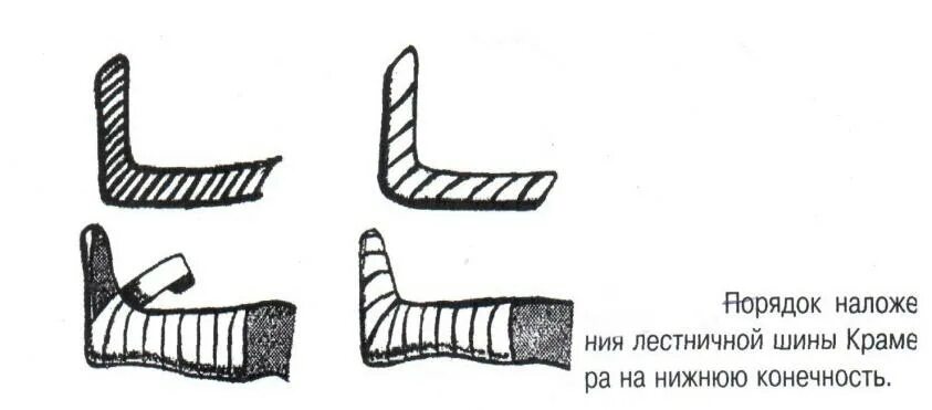 Лестничная крамера. Лестничные шины (шины крамера),. малая шина крамера повязка. лестничная шина крамера. стандартная шина крамера.