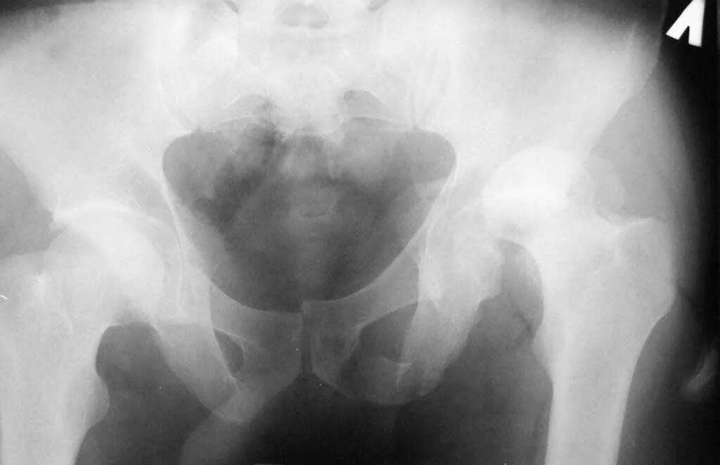 Перелом правой вертлужной впадины таза. Полипроекционная рентгенография таза. Рентгенография вертлужной впадины. Перелом вертлужной впадины мкб. Перелом вертлужной впадины мкб.