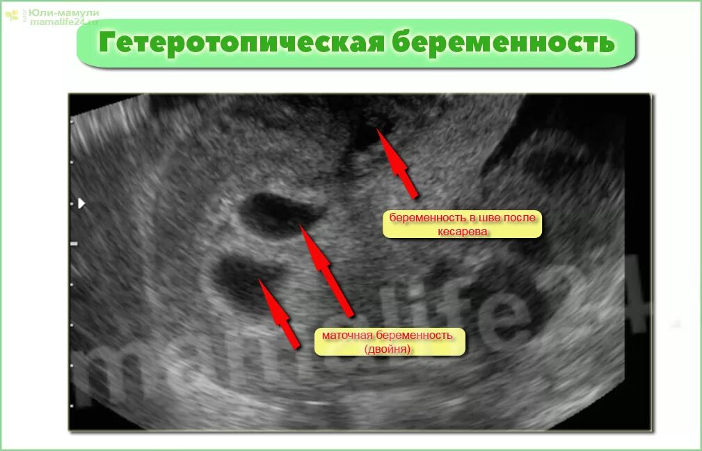 Ли сохранить внематочную беременность. Маточная и внематочная беременность УЗИ. Внематочная беременность на УЗИ. Маточная беременность УЗИ. Трубная беременность УЗИ.