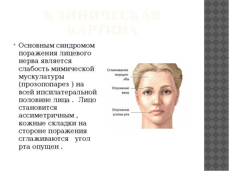 Парез лицевого нерва синдром. Парез мимической мускулатуры лицевого нерва.