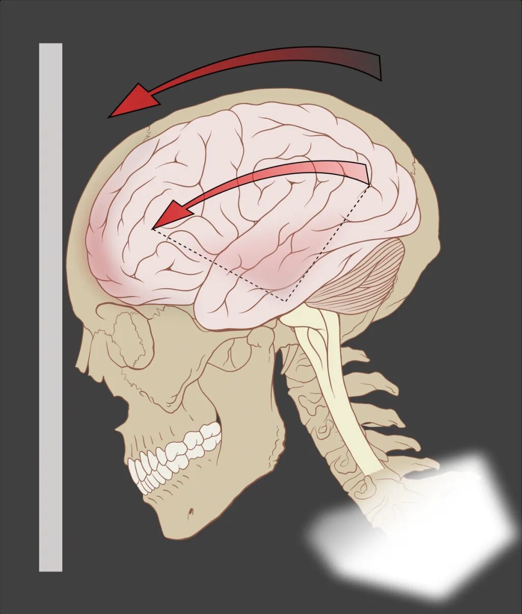 Сотрясение головы и головного мозга.