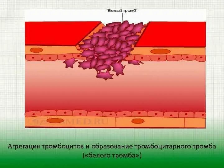 Агрегация тромбоцитарного тромба. Образование тромбоцитарного тромба. Строение красного тромба. Смешанные тромбы строение. Строение тромба