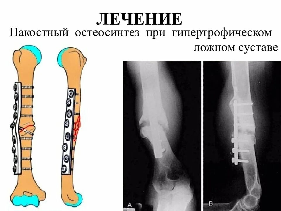 После ложных