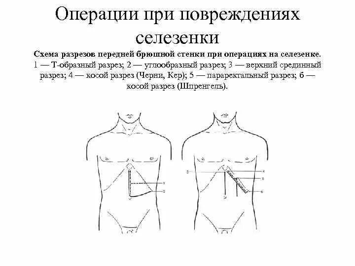 Операции на селезенке. Доступ черни Кера к селезенке. Парамедианный разрез брюшной стенки. Разрез при спленэктомии. Разрез по черни при холецистэктомии.