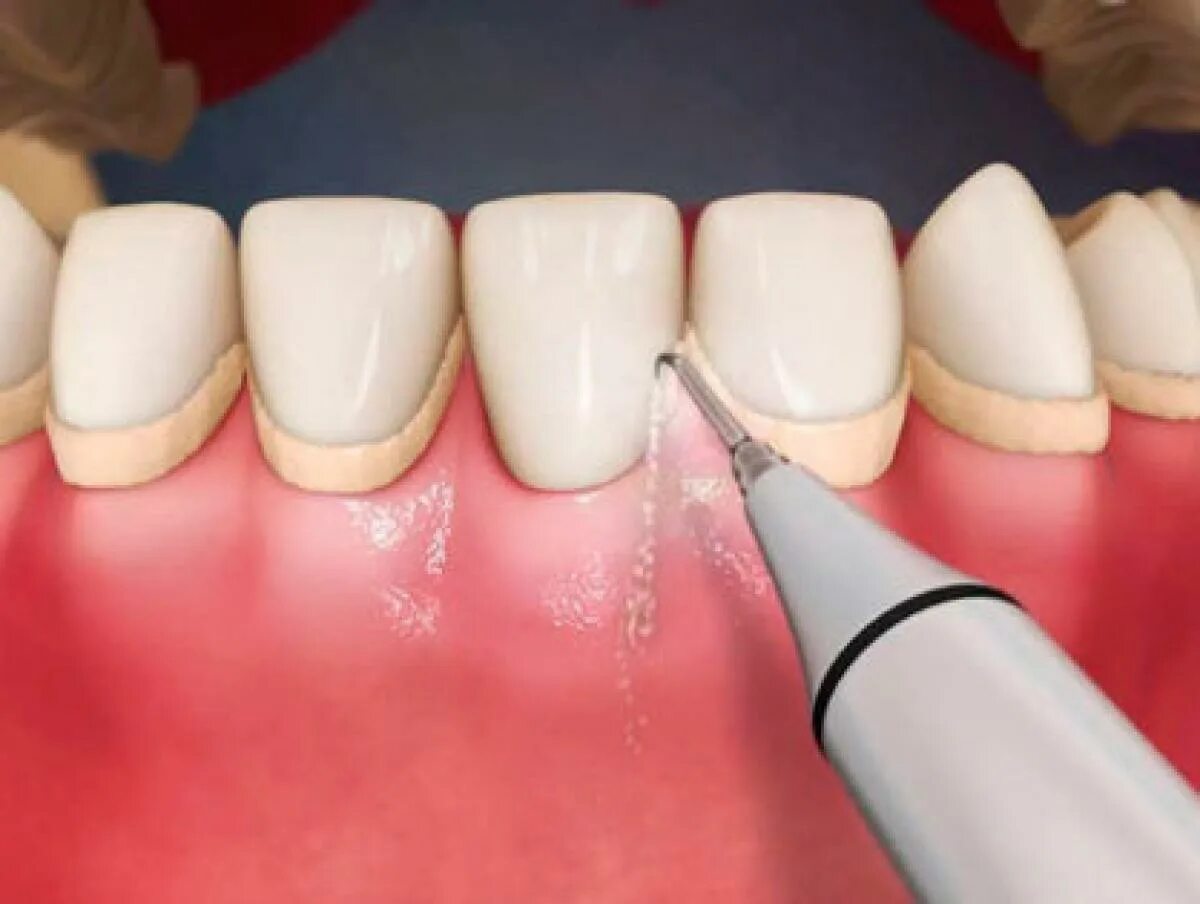 Профгигиена (ультразвук + Air-Flow). Поддесневой зубной камень. Ультрозвуковая проф гигиена. Поддесневой белый зубной камень.