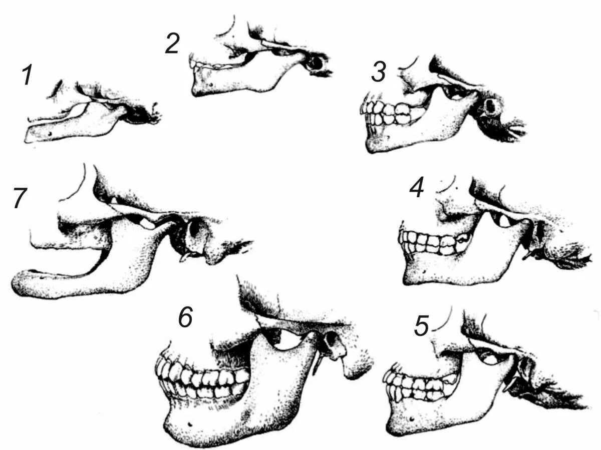 Мыщелок челюсти. Анатомия сустава ВНЧС. Нижнечелюстная ямка ВНЧС. , Возрастные изменения височнонижний челюст сустав.