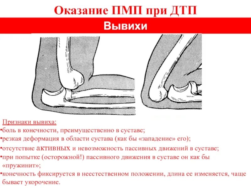 Вывих определение. Основной признак вывиха. сообщение на тему вывих. характерные симптомы вывиха.
