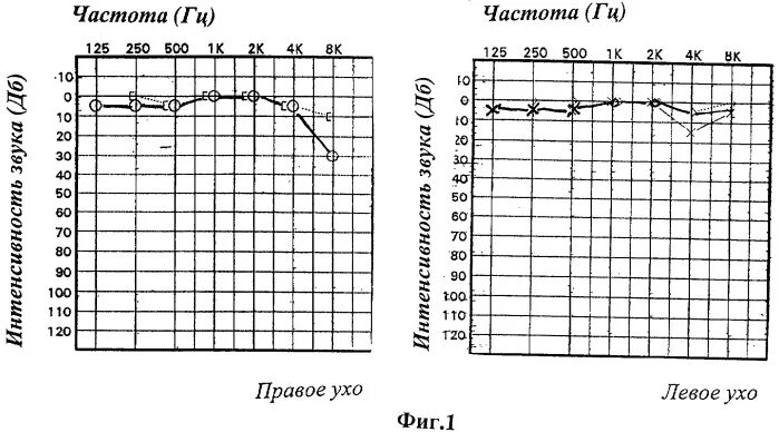 Тональная пороговая аудиометрия с тестом Вебера. Аудиометрия с тестом Вебера что это. Аудиограмма при неврите слухового нерва. Тональная аудиометрия с тестом Вебера что это. Аудиограмма ребенку