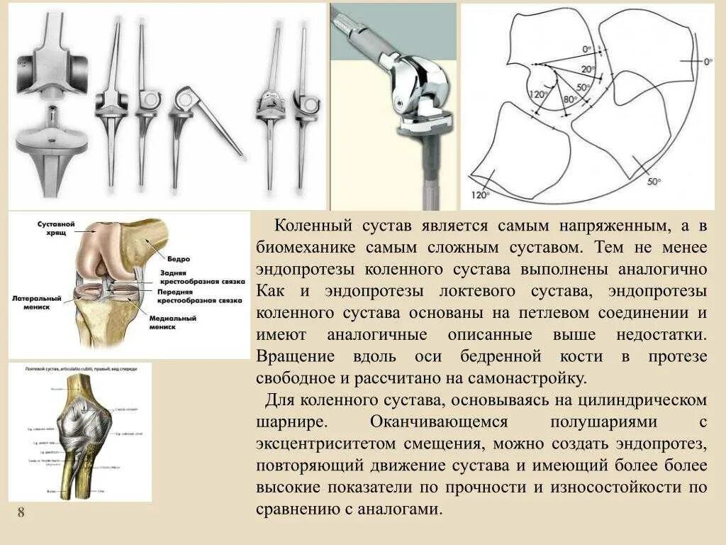 Эндопротезирование коленного сустава время операции. Эндопротез коленного сустава. артроз коленного сустава эндопротезирование. эндопротезирование коленного сустава топографическая анатомия. одномыщелковый эндопротез коленного сустава.